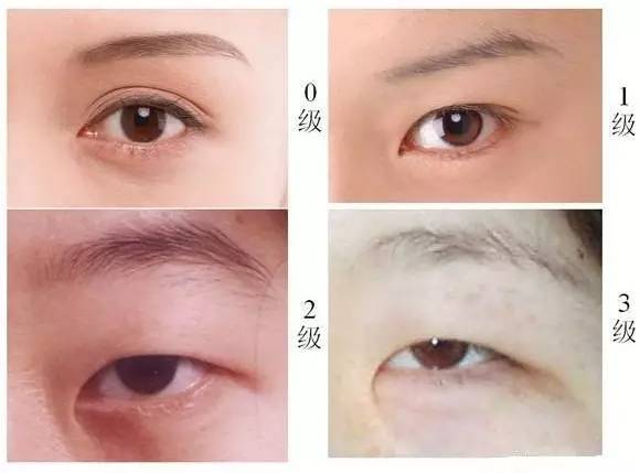 双眼皮术后后遗症，了解可能的风险与预防措施