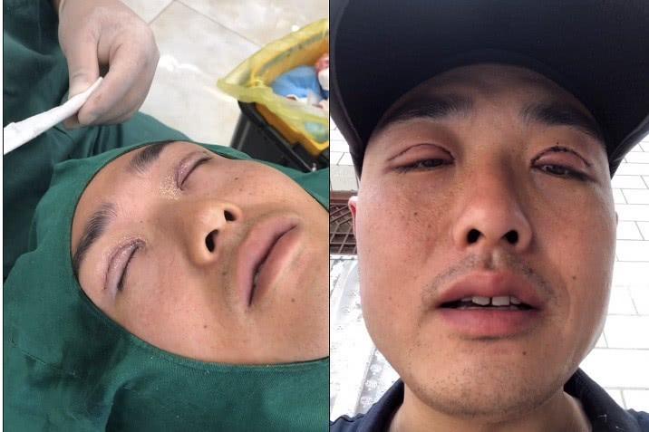 双眼皮手术，影响与注意事项