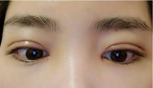 双眼皮手术，美丽背后的潜在后遗症