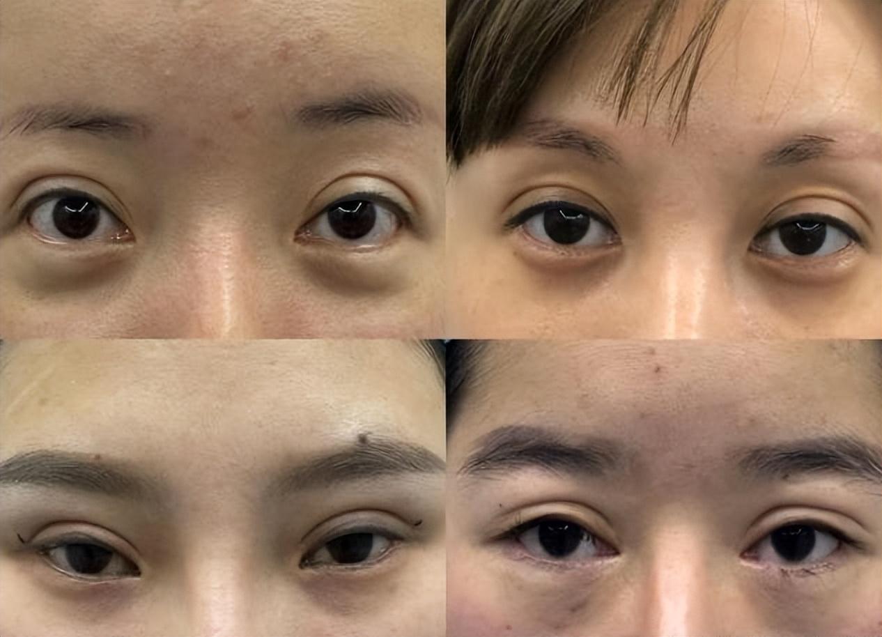 双眼皮手术，对眼睛影响的深度解析