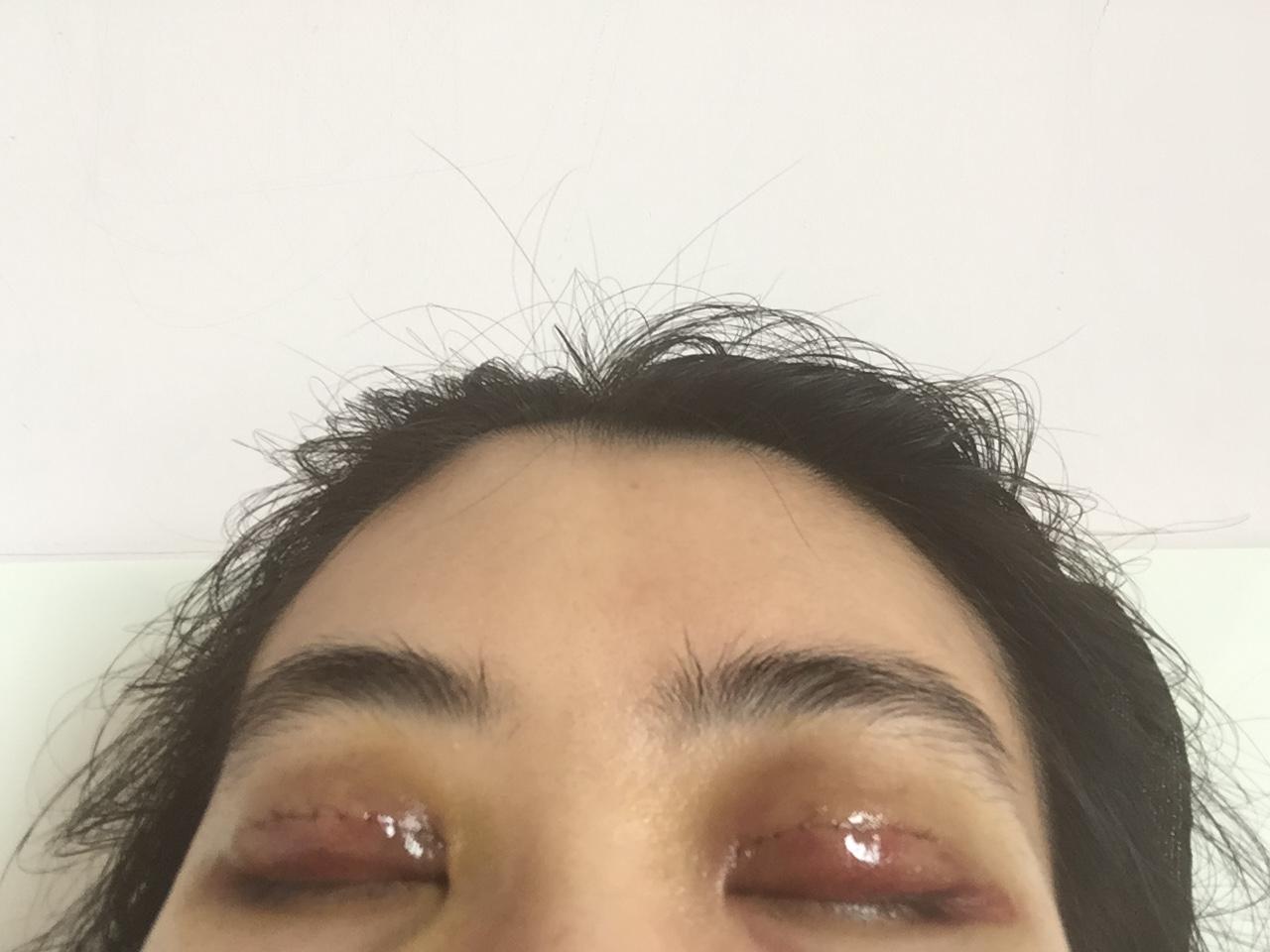 双眼皮手术对财运的影响，迷信与现实的碰撞