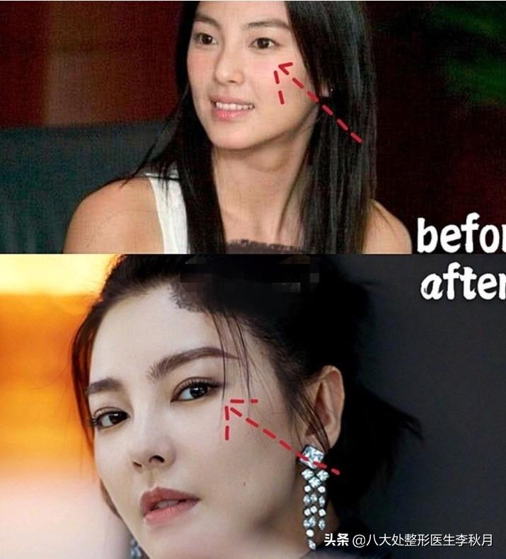 双眼皮手术后的长期影响及其对日常生活的影响