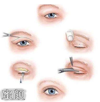 做双眼皮手术，风险与安全指南