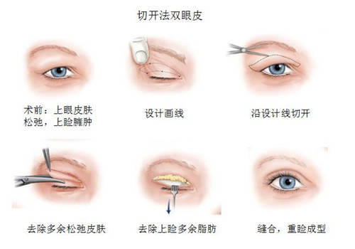 双眼皮手术的潜在危害及其长期影响