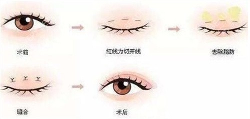 双眼皮手术对身体的影响及其注意事项