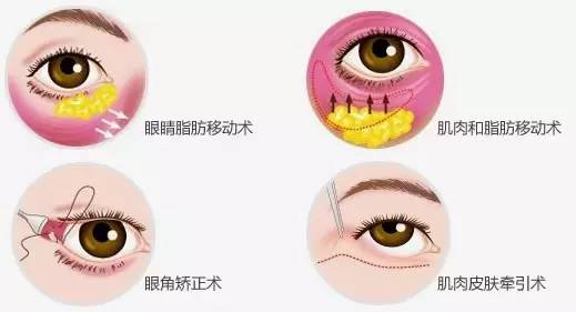 双眼皮手术对身体的影响及其注意事项
