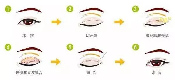 双眼皮手术，效果、风险与术后护理全解析