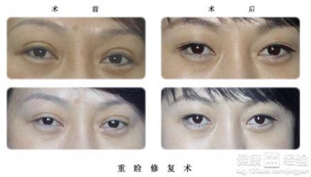 双眼皮手术，效果、风险与后遗症全面解析