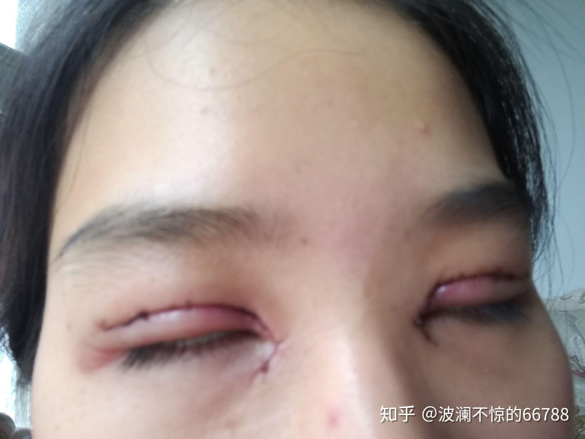 双眼皮手术恢复过程全记录，从术后第一天到完全康复