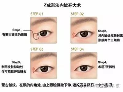 双眼皮手术的风险与可能的后遗症，全面解析与预防建议
