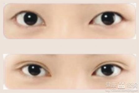 双眼皮手术的风险与可能的后遗症，全面解析与预防建议