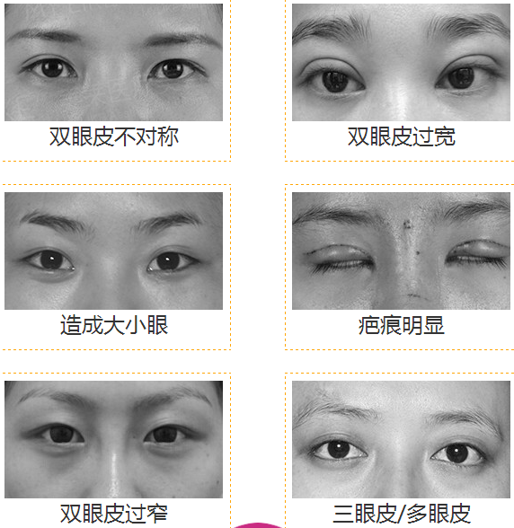 双眼皮手术的风险与可能的后遗症，全面解析与预防建议