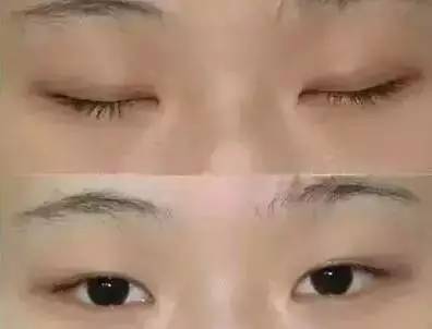 双眼皮手术后的潜在后遗症及其预防措施