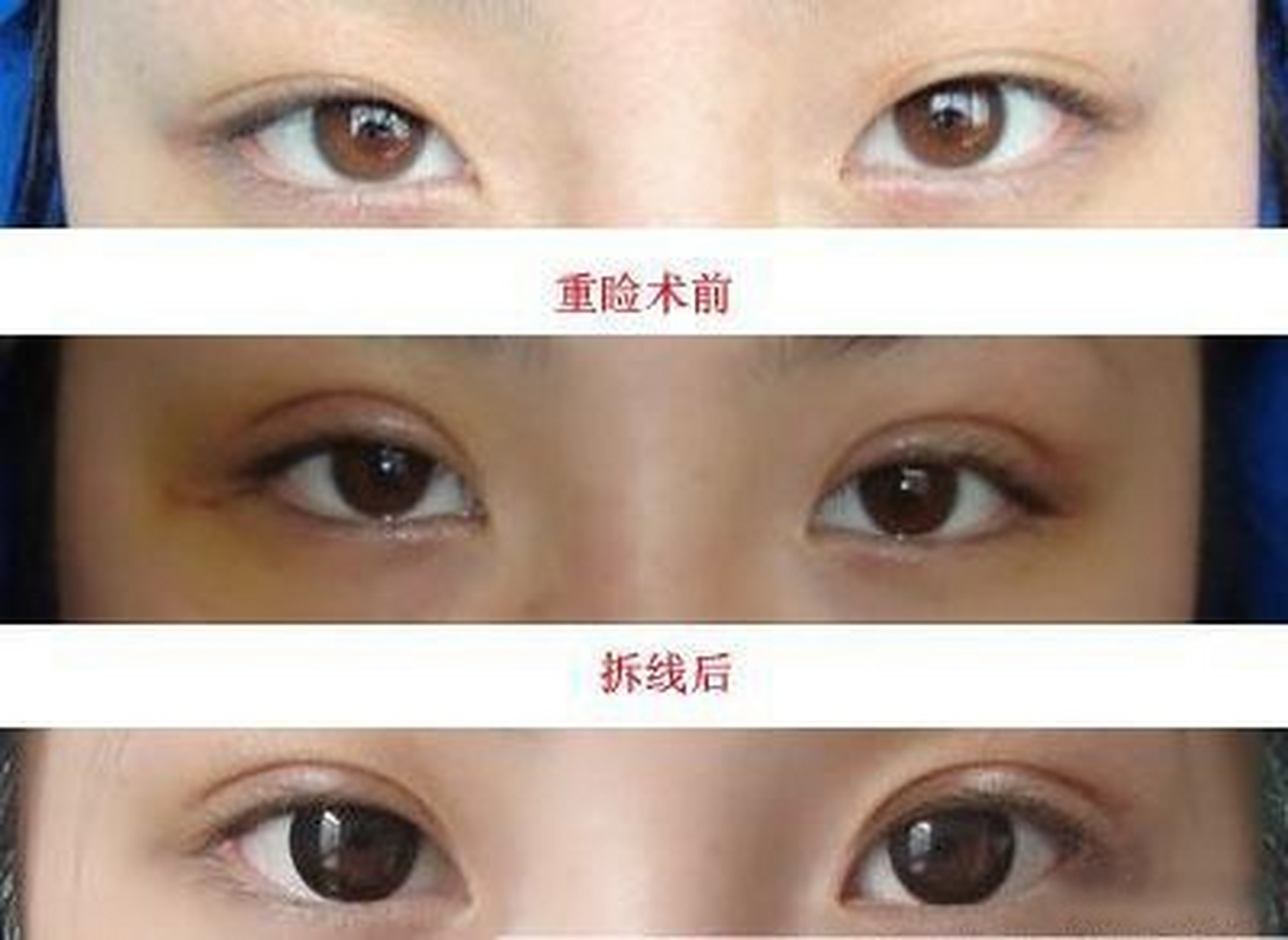双眼皮手术后的潜在后遗症及其预防措施