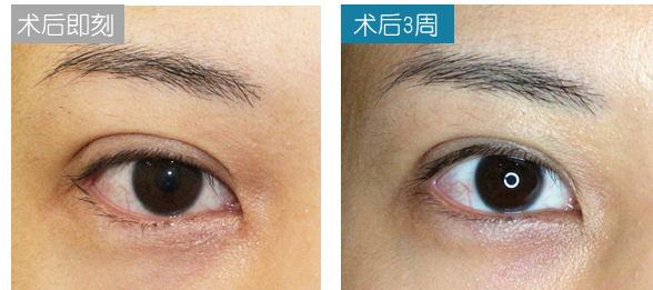 双眼皮手术后的潜在后遗症及其应对策略