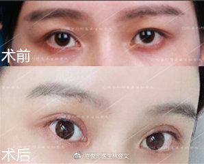 双眼皮手术后的潜在后遗症及其应对策略