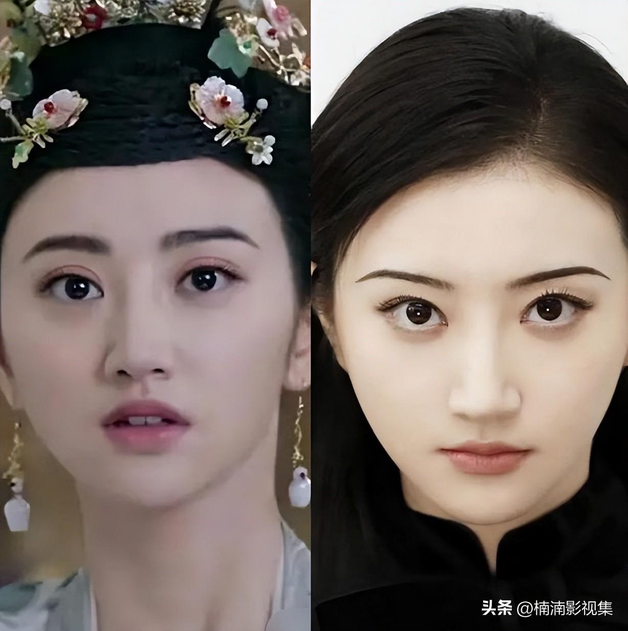 双眼皮手术后的常见后遗症及其预防措施