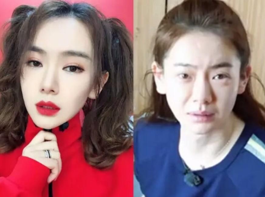 双眼皮手术，后遗症与风险全解析